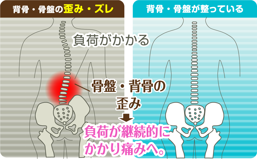 正常な骨盤と歪んでいる骨盤の図