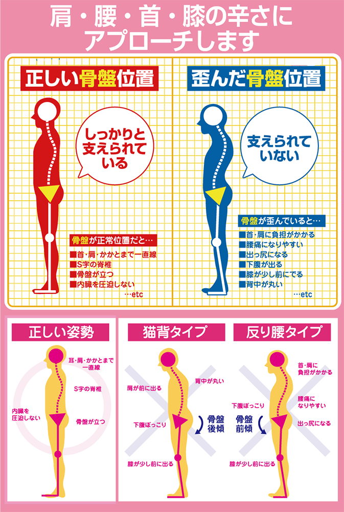 骨盤の歪みのメカニズムの図